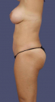 Liposuction 2 - Abdomen, Flanks, & Back After